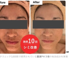 上野・御徒町のフェイシャルエステLa・Junavieでのビフォーアフター